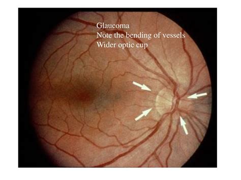 Ppt Identify Vein Artery Disc Optic Cup Fovea Powerpoint