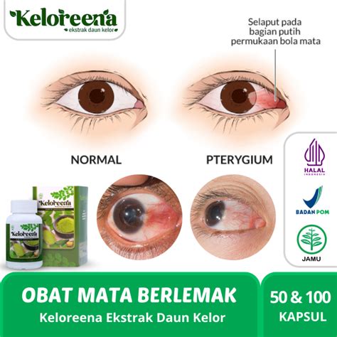 Keloreena Kapsul Obat Mata Berlemak Obat Pembersih Pterigium