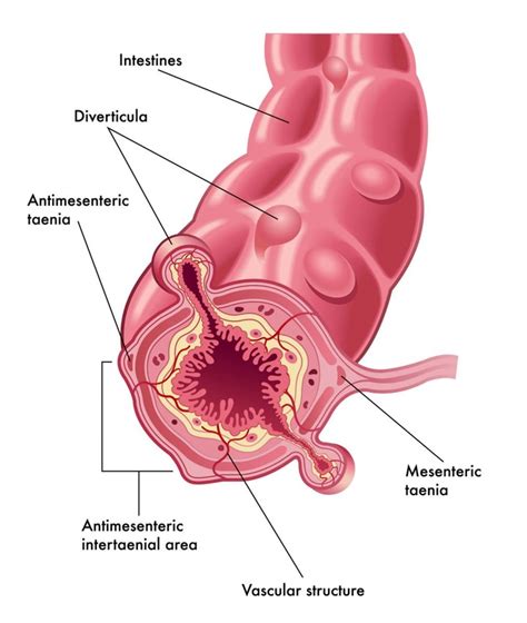 Diagram Of Diverticulosis