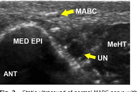 Figure 3 From The Snapping Medial Antebrachial Cutaneous Nerve Semantic Scholar