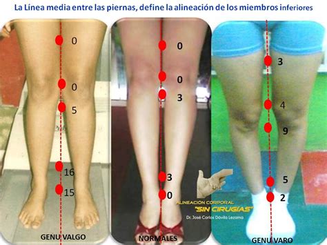 Sin Cirug As En L Nea C Mo Son Tus Piernas