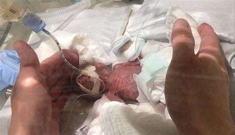 World's smallest baby boy weighing 268 grams sent home healthy – India TV