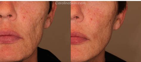 Best Acne Scars Treatment In Charlotte Nc Dlvsc