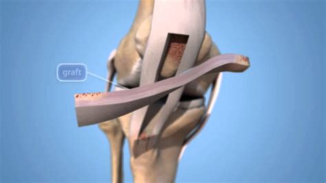 Acl Reconstruction Youtube