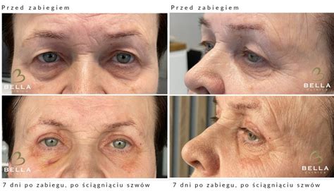 Blepharoplastyka Bella Clinica