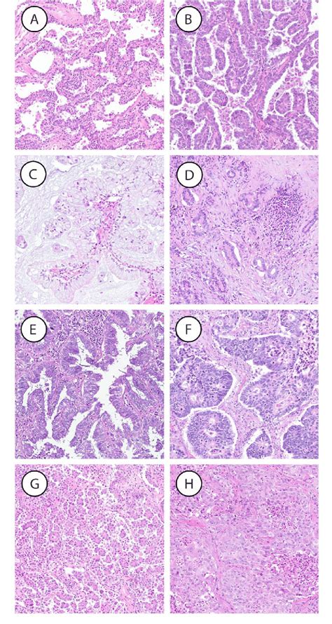 Representative Examples Of Different Histological Subtypes In Lung