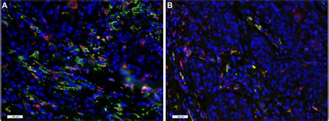 Cd163 And Cd68 Double Staining Of An Hrhpv − A And Hrhpv B Download Scientific Diagram