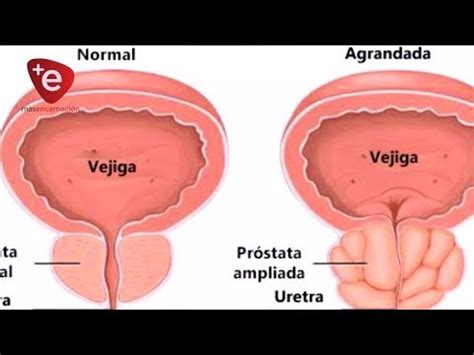 AGRANDAMIENTO DE LA PRÓSTATA ES NORMAL EN ADULTOS MAYORES Y NO ES UN