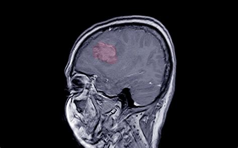 Advancements in Meningioma Treatment Options: What You Need to Know ...