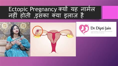 Ectopic Pregnancy Hindi