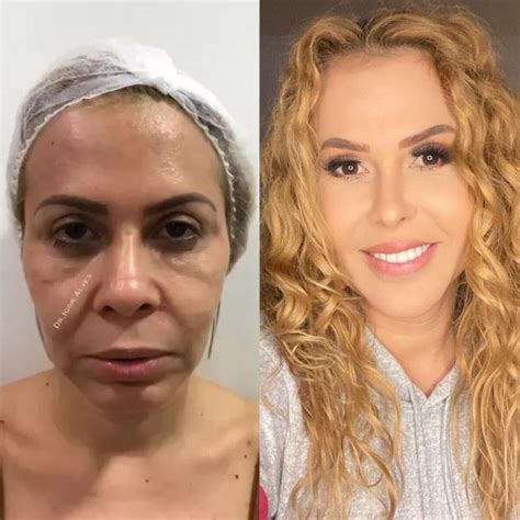 Foto Antes e depois Joelma fez harmonização facial e realçou seus