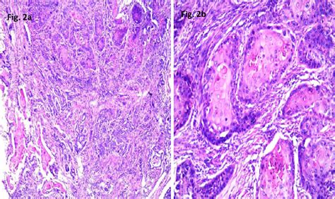 A Microscopy Showing Squamous And Adenocarcinoma Components With