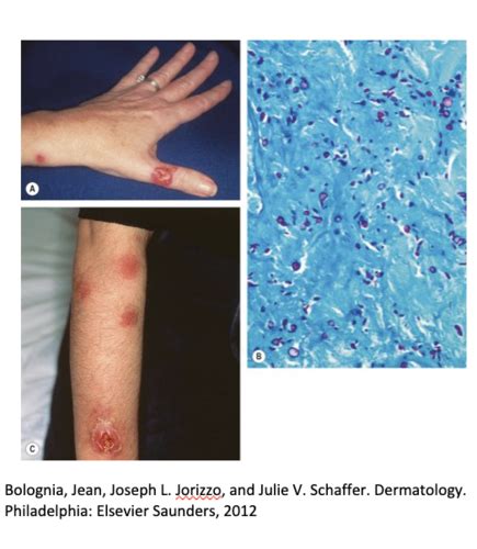 14 Dermatologic Infectious Diseases Ii Flashcards Quizlet