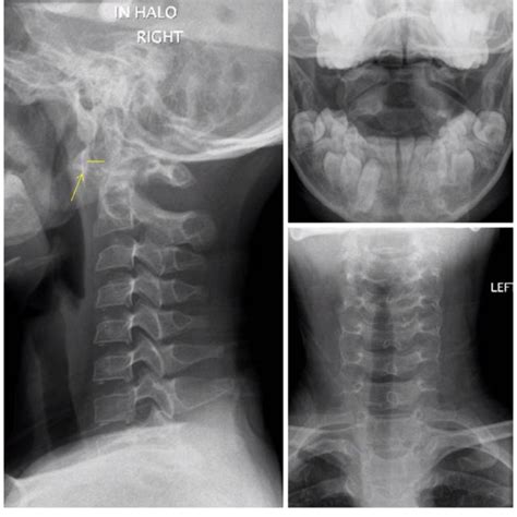 Flexion Extension Lateral Cervical Spine X Rays Confirming Significant Download Scientific