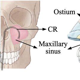 a Location of the maxillary sinus. b The ostium is located on the... | Download Scientific Diagram