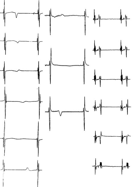 Changes In The Intracardiac Electrocardiogram After Ba 2 A