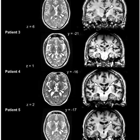 Transverse And Coronal Structural Mr Images And Lesion Locations For