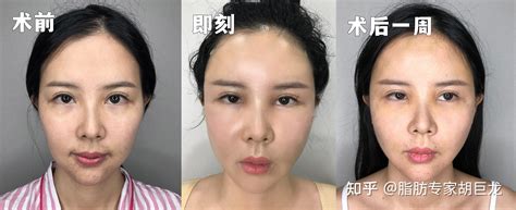 做完面部脂肪填充后过多久，才能恢复自然？ 知乎