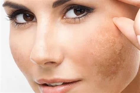 Peeling Para Manchas En La Piel Dr Vladimir Rovira