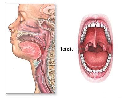 Health Care: Tonsils and Bad Breath