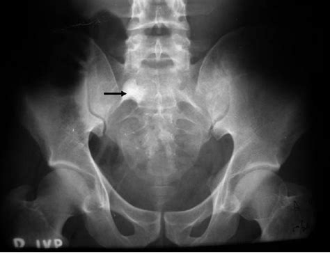 Intravenous Pyelogram Showing A Calculus Arrow In The Left Renal