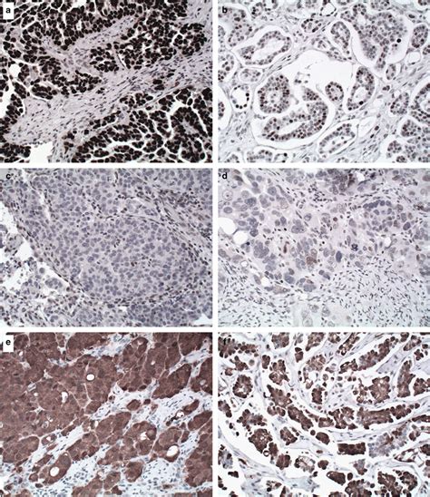 The Diagnostic Utility Of Tp And Cdkn A To Distinguish Ovarian High