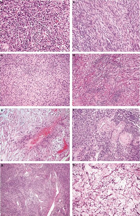 Inflammatory Myofibroblastic Tumor Of The Uterus A Clinicopathological