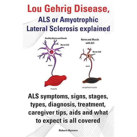 Buy Lou Gehrig Disease, ALS or Amyotrophic Lateral Sclerosis explained ...