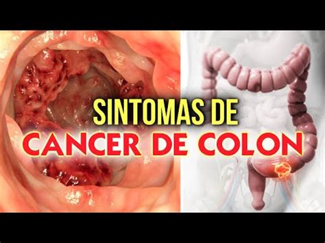 S Ntomas Del Cancer De Colon Conozca Causas Y S Ntomas Del Cancer De