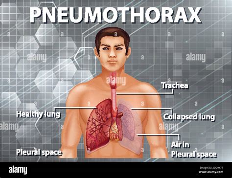 Human Anatomy Pneumothorax Diagram Illustration Stock Vector Image