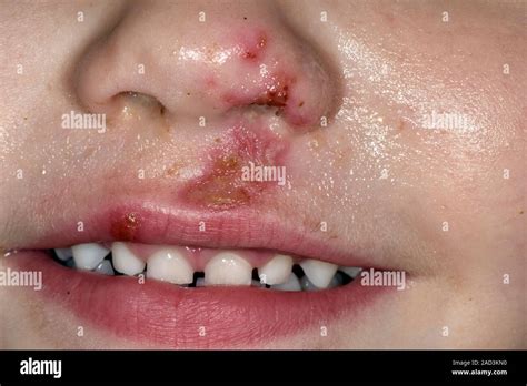 Impetigo on the face. Close-up of a rash on the face of a 3-year-old ...