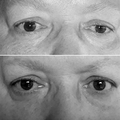 Transconjunctival And Transcutaneous Application Of Incobotulinumtoxina