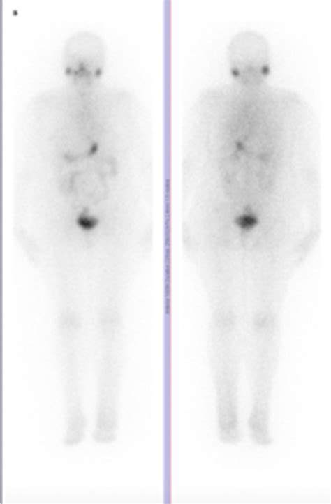 Whole Body Scan With I Sodium Iodide I Wbs With Mci