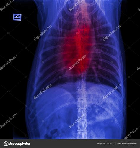 Blastomycosis Lung X Ray