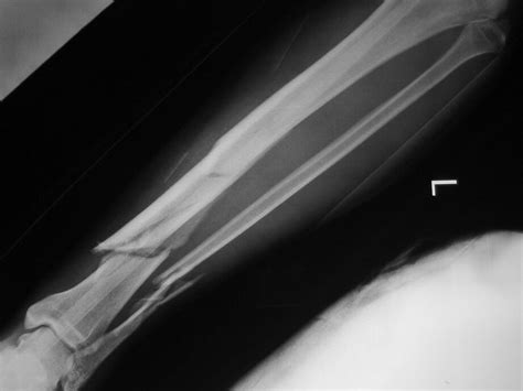 Fracture du péroné comment identifier les signes sur une radiographie