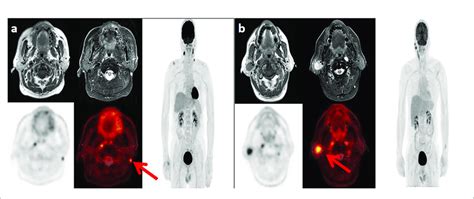 Lymph Node Metastases In Two Patients With Nasopharyngeal Carcinoma