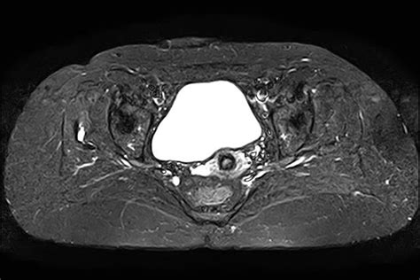 Trochanteric Bursitis Image