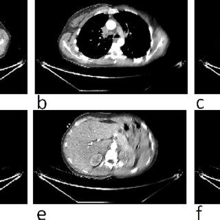 Comparison Between Reconstructed Cardiac CT Images In The Chest And