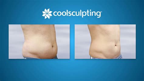 Male Patient Wows With Coolsculpting Before And After Results On Abdomen Youtube