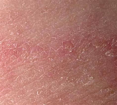 Tinea Fungal Skin Infections