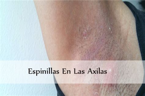 Cura Tu Infección Axilar InfoAxilas