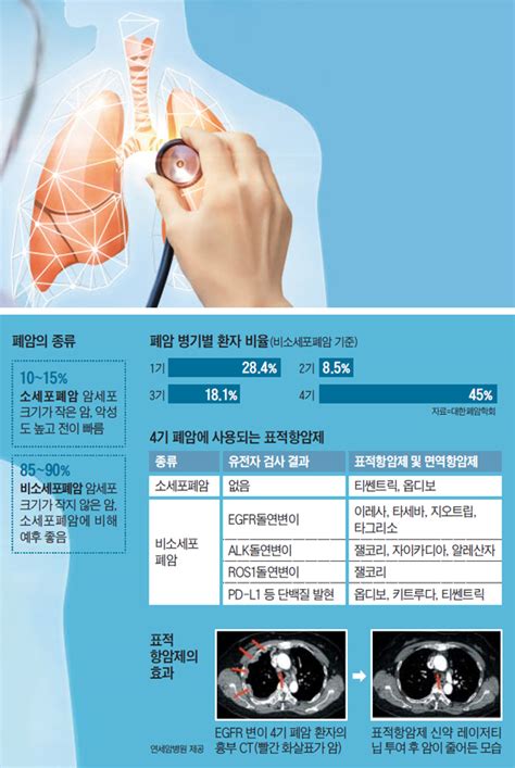 치료 무기 많아진 폐암 4기암 생존 기간 5배 네이버 블로그