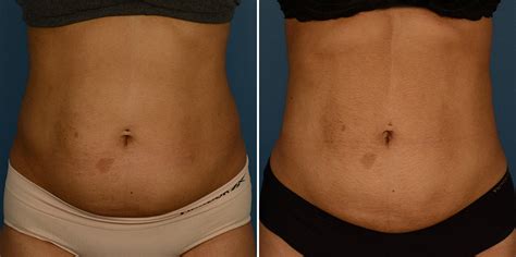 Vaser Liposuction Photos Naples Fl Patient