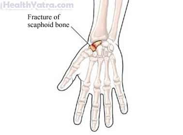 Wrist Fracture Definition, Causes, Symptoms, Cost Treatment in India