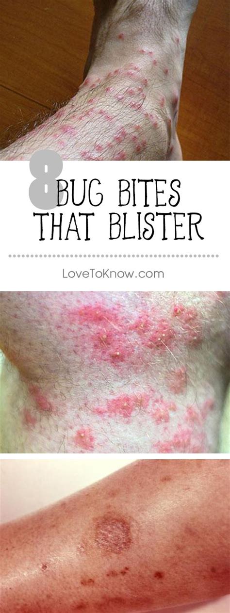 8 Bug Bites That Blister Bug Bites That Blister Bug Bites Spider Bite Treatment