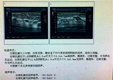 拿到乳腺b超报告看不懂？一招教你解读 硕世互联网医院