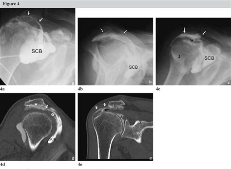 Figure From Subcoracoid Bursa Imaging Diagnosis And Significance