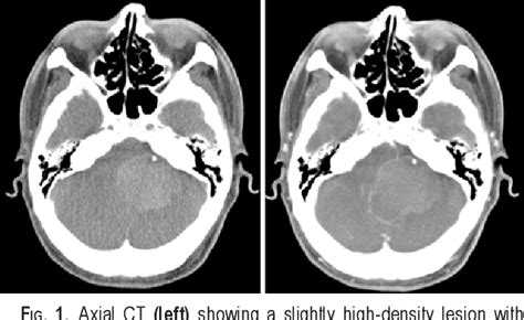 Figure From Primary Intracranial Ectopic Craniopharyngioma In A