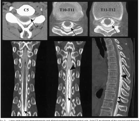 Pdf Intradural Spinal Vein Enlargement In Craniospinal Hypotension