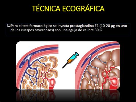 Figure 10 from ECOGRAFÍA DOPPLER PENEANA EN EL ESTUDIO DE LA DISFUNCIÓN